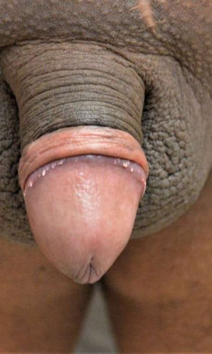 Permanent Penis Enlargement Before & After Patient #1443