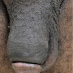 Permanent Penis Enlargement Before & After Patient #1446