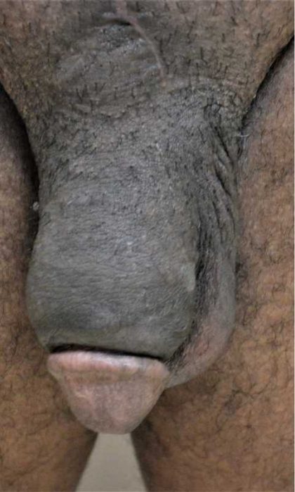 Permanent Penis Enlargement Before & After Patient #1446
