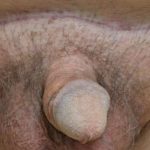Permanent Penis Enlargement Before & After Patient #1449