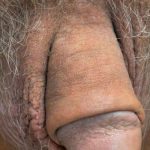 Permanent Penis Enlargement Before & After Patient #1455