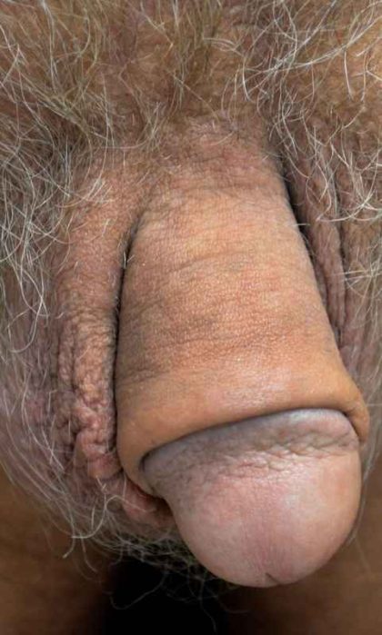 Permanent Penis Enlargement Before & After Patient #1455