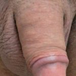 Permanent Penis Enlargement Before & After Patient #1458