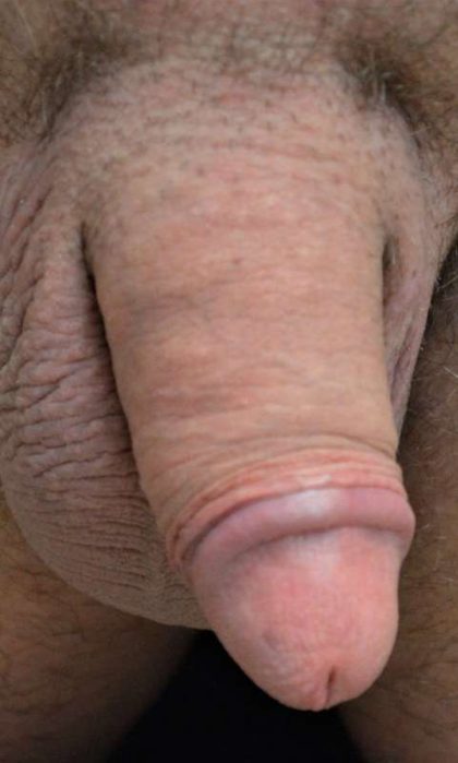 Permanent Penis Enlargement Before & After Patient #1458