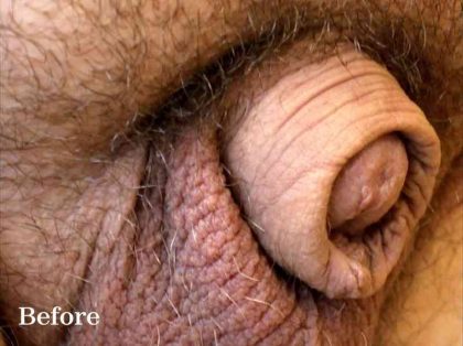Retracted Buried Penis Before & After Patient #1260