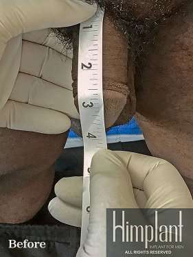 Himplant Before & After Patient #1311