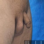 Himplant Before & After Patient #1326