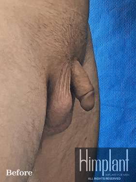 Himplant Before & After Patient #1326