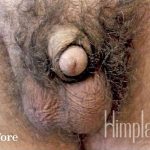 Retracted Buried Penis Before & After Patient #1266
