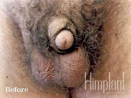 Retracted Buried Penis Before & After Patient #1266
