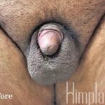 Retracted Buried Penis Before & After Patient #1269