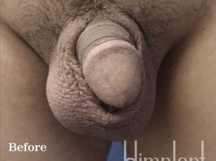 Retracted Buried Penis Before & After Patient #1257
