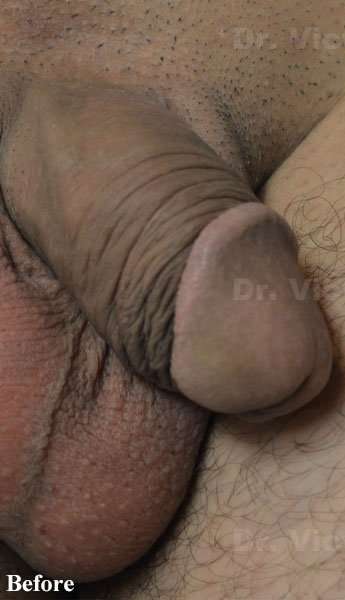 Permanent Penis Enlargement Before & After Patient #1395