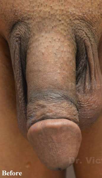 Permanent Penis Enlargement Before & After Patient #1398