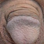 Permanent Penis Enlargement Before & After Patient #1404