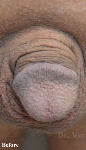 Permanent Penis Enlargement Before & After Patient #1404