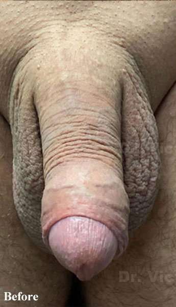 Permanent Penis Enlargement Before & After Patient #1407