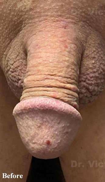 Permanent Penis Enlargement Before & After Patient #1410