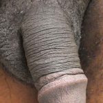 Permanent Penis Enlargement Before & After Patient #1413