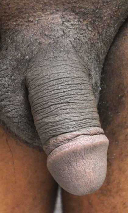 Permanent Penis Enlargement Before & After Patient #1413