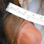 Permanent Penis Enlargement Before & After Patient #1425