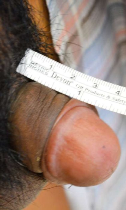 Permanent Penis Enlargement Before & After Patient #1425