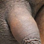 Permanent Penis Enlargement Before & After Patient #1428
