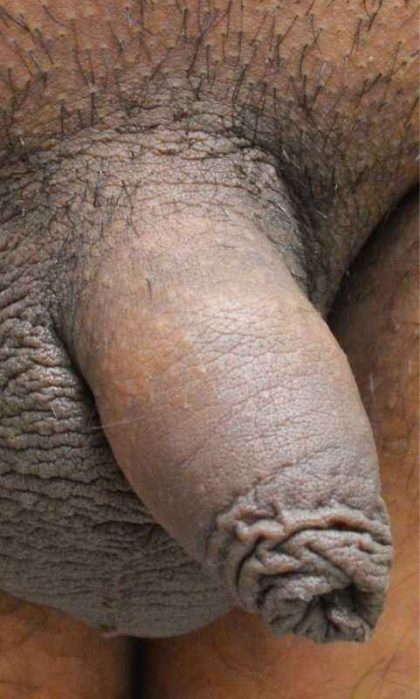 Permanent Penis Enlargement Before & After Patient #1428