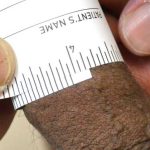 Permanent Penis Enlargement Before & After Patient #1431