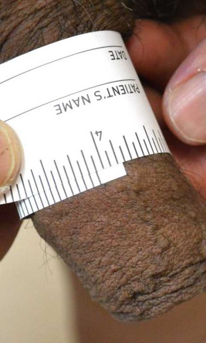 Permanent Penis Enlargement Before & After Patient #1431