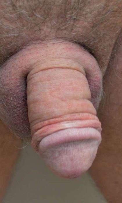 Permanent Penis Enlargement Before & After Patient #1434
