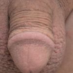 Permanent Penis Enlargement Before & After Patient #1437
