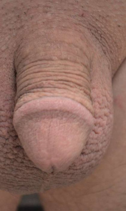 Permanent Penis Enlargement Before & After Patient #1437