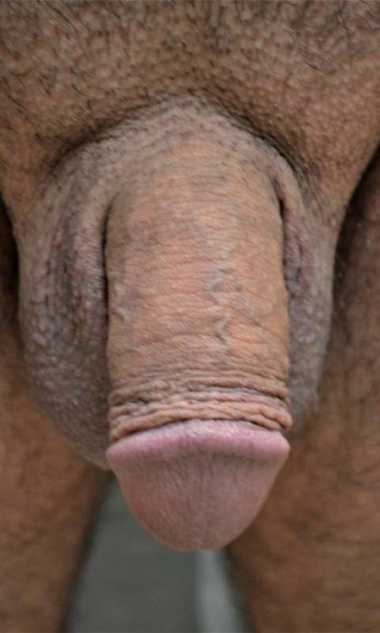 Permanent Penis Enlargement Before & After Patient #1440