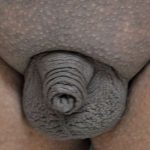Permanent Penis Enlargement Before & After Patient #1443