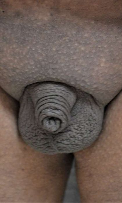 Permanent Penis Enlargement Before & After Patient #1443