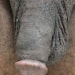 Permanent Penis Enlargement Before & After Patient #1446