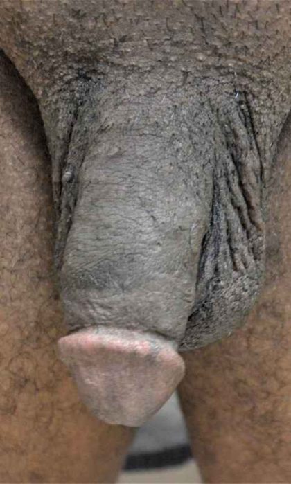 Permanent Penis Enlargement Before & After Patient #1446