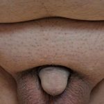 Permanent Penis Enlargement Before & After Patient #1449