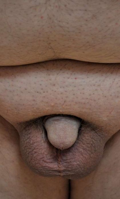 Permanent Penis Enlargement Before & After Patient #1449