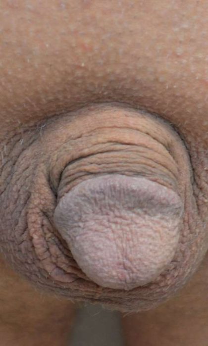 Permanent Penis Enlargement Before & After Patient #1455