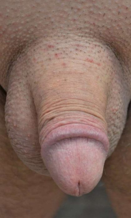 Permanent Penis Enlargement Before & After Patient #1458