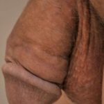 Permanent Penis Enlargement Before & After Patient #1461
