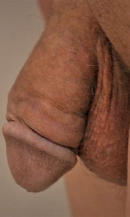 Permanent Penis Enlargement Before & After Patient #1461
